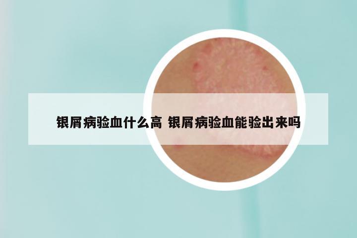 银屑病验血什么高 银屑病验血能验出来吗