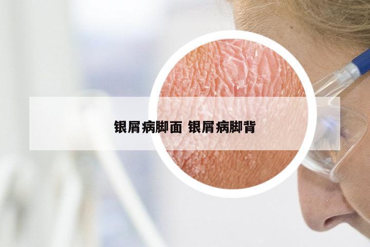 银屑病脚面 银屑病脚背