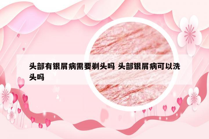 头部有银屑病需要剃头吗 头部银屑病可以洗头吗