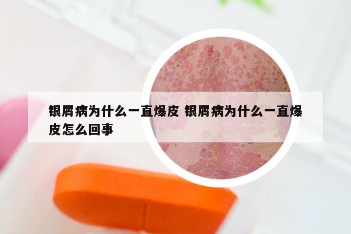 银屑病为什么一直爆皮 银屑病为什么一直爆皮怎么回事