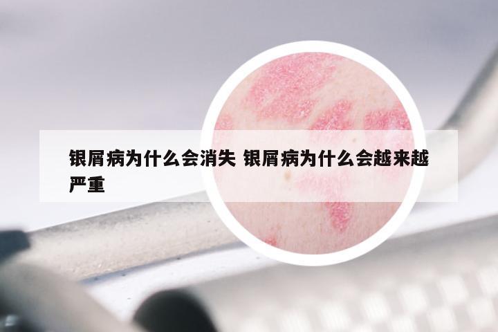 银屑病为什么会消失 银屑病为什么会越来越严重