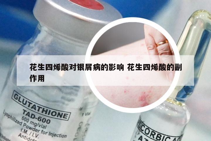 花生四烯酸对银屑病的影响 花生四烯酸的副作用