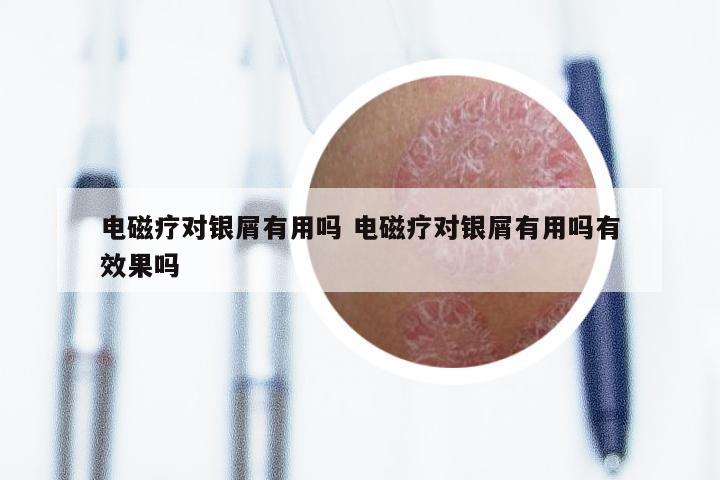 电磁疗对银屑有用吗 电磁疗对银屑有用吗有效果吗