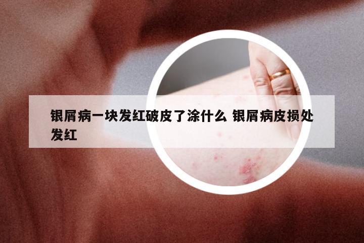 银屑病一块发红破皮了涂什么 银屑病皮损处发红