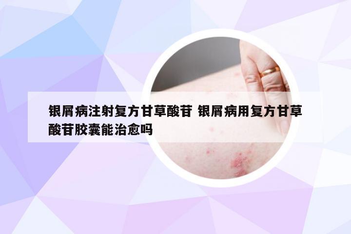 银屑病注射复方甘草酸苷 银屑病用复方甘草酸苷胶囊能治愈吗