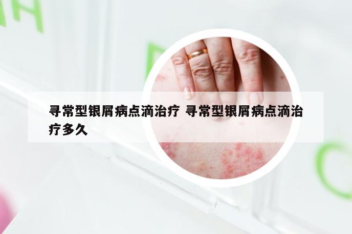 寻常型银屑病点滴治疗 寻常型银屑病点滴治疗多久