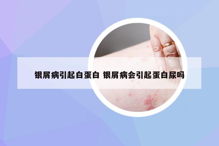 银屑病引起白蛋白 银屑病会引起蛋白尿吗