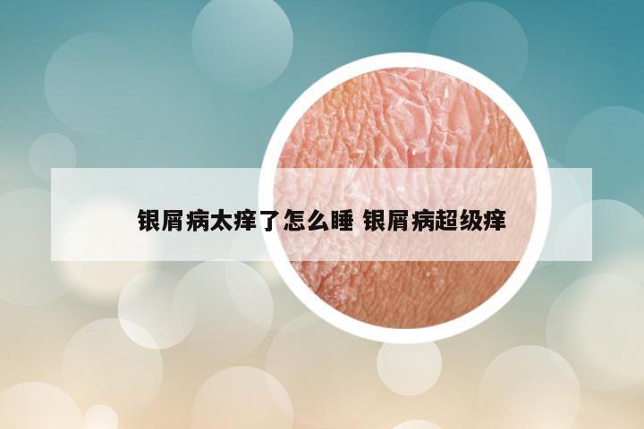 银屑病太痒了怎么睡 银屑病超级痒