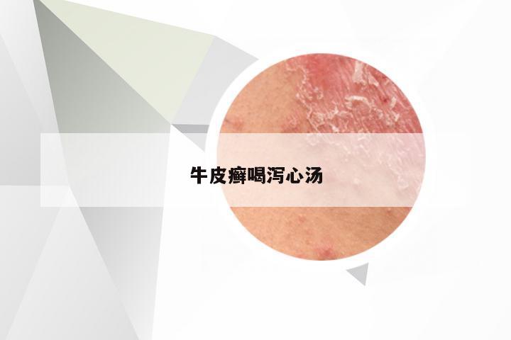 牛皮癣喝泻心汤