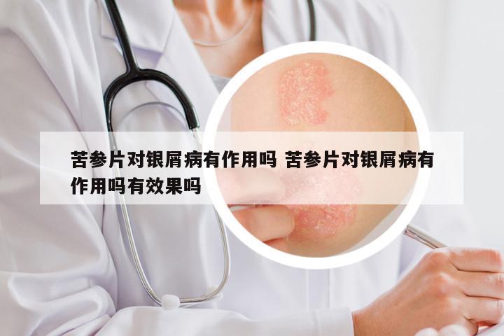 苦参片对银屑病有作用吗 苦参片对银屑病有作用吗有效果吗