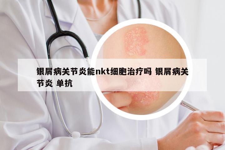 银屑病关节炎能nkt细胞治疗吗 银屑病关节炎 单抗
