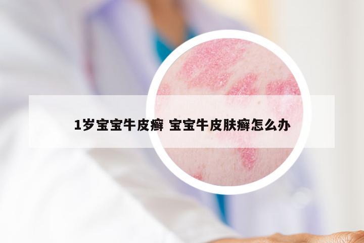 1岁宝宝牛皮癣 宝宝牛皮肤癣怎么办