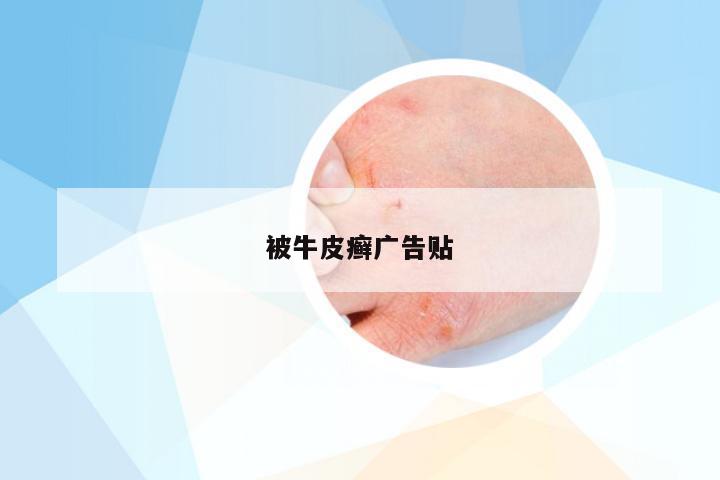 被牛皮癣广告贴