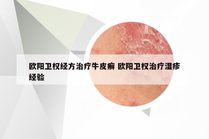 欧阳卫权经方治疗牛皮癣 欧阳卫权治疗湿疹经验