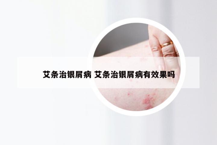 艾条治银屑病 艾条治银屑病有效果吗