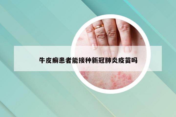 牛皮癣患者能接种新冠肺炎疫苗吗