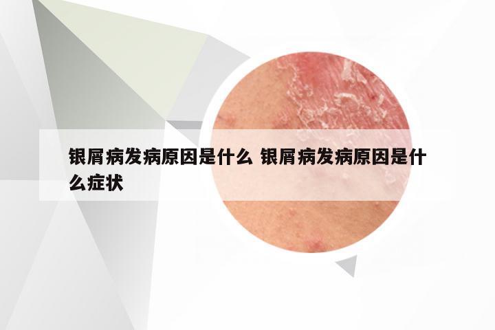 银屑病发病原因是什么 银屑病发病原因是什么症状
