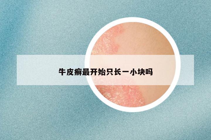 牛皮癣最开始只长一小块吗