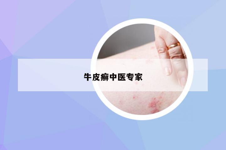 牛皮癣中医专家