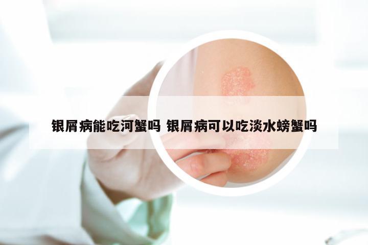 银屑病能吃河蟹吗 银屑病可以吃淡水螃蟹吗