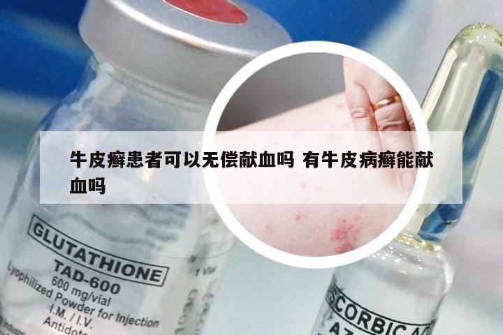 牛皮癣患者可以无偿献血吗 有牛皮病癣能献血吗