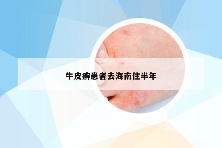 牛皮癣患者去海南住半年