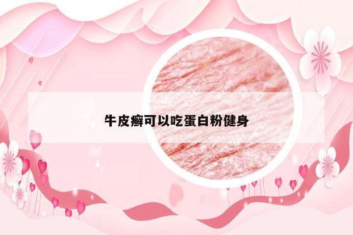 牛皮癣可以吃蛋白粉健身