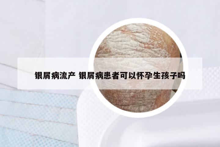 银屑病流产 银屑病患者可以怀孕生孩子吗