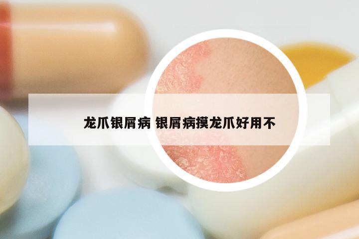 龙爪银屑病 银屑病摸龙爪好用不