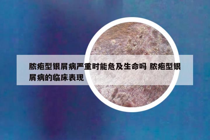脓疱型银屑病严重时能危及生命吗 脓疱型银屑病的临床表现