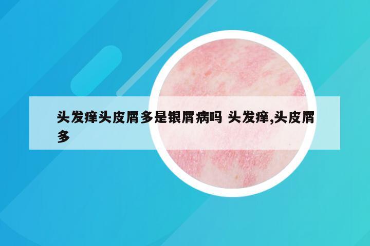头发痒头皮屑多是银屑病吗 头发痒,头皮屑多