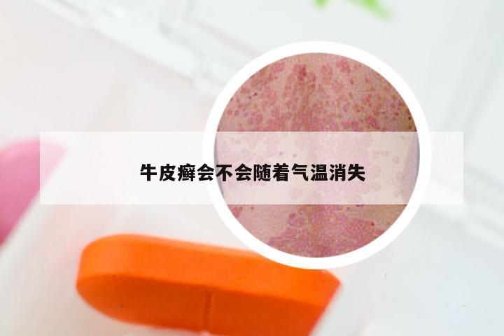 牛皮癣会不会随着气温消失