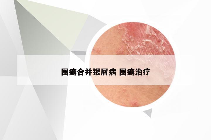 圈癣合并银屑病 圈癣治疗