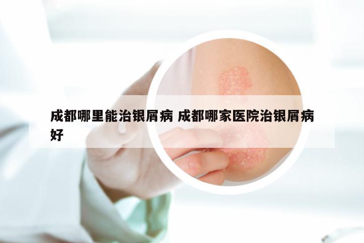 成都哪里能治银屑病 成都哪家医院治银屑病好