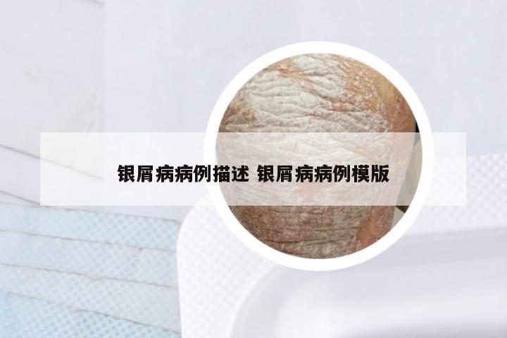 银屑病病例描述 银屑病病例模版