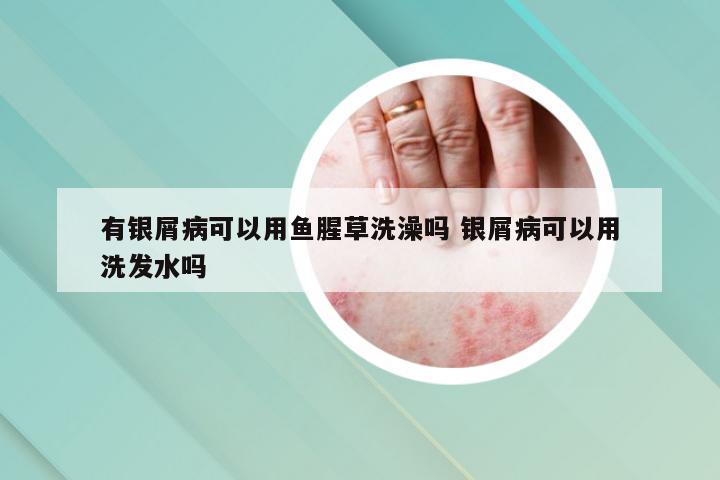有银屑病可以用鱼腥草洗澡吗 银屑病可以用洗发水吗
