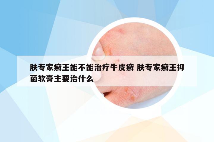 肤专家癣王能不能治疗牛皮癣 肤专家癣王抑菌软膏主要治什么