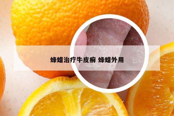 蜂蜡治疗牛皮癣 蜂蜡外用