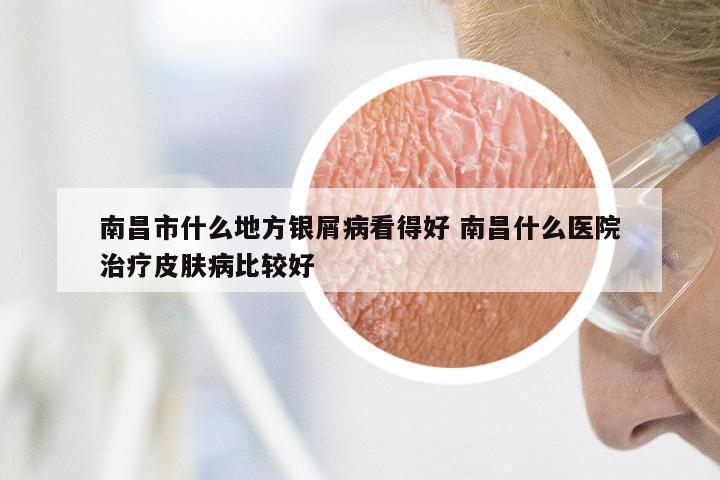 南昌市什么地方银屑病看得好 南昌什么医院治疗皮肤病比较好