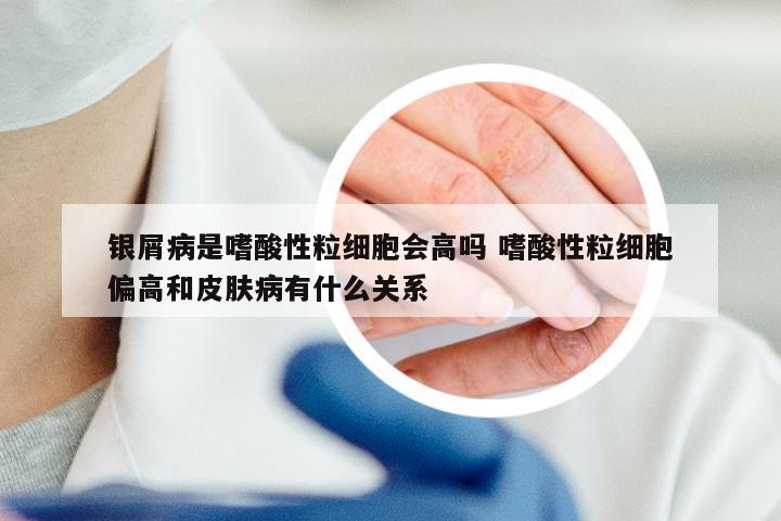 银屑病是嗜酸性粒细胞会高吗 嗜酸性粒细胞偏高和皮肤病有什么关系