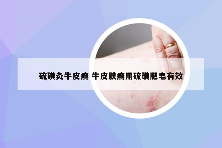 硫磺灸牛皮癣 牛皮肤癣用硫磺肥皂有效
