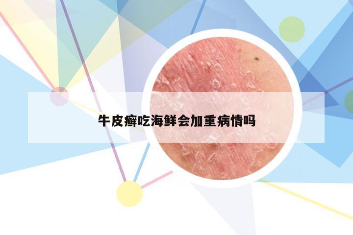 牛皮癣吃海鲜会加重病情吗