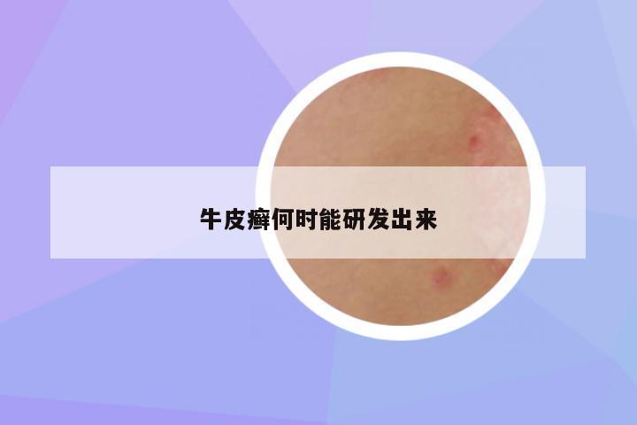 牛皮癣何时能研发出来