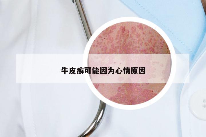 牛皮癣可能因为心情原因