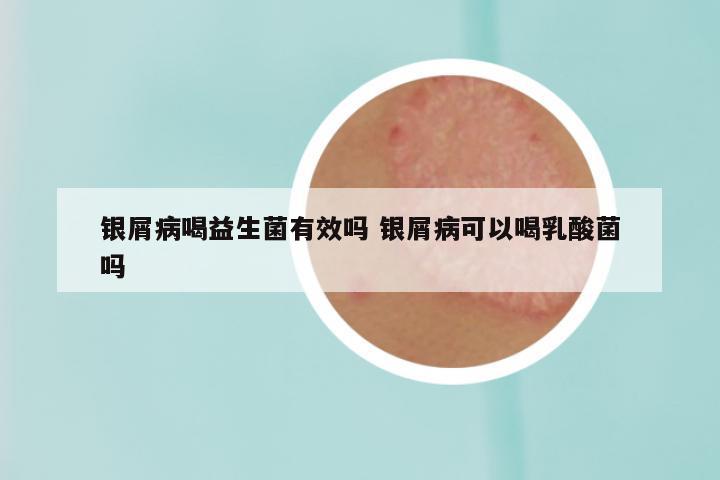 银屑病喝益生菌有效吗 银屑病可以喝乳酸菌吗
