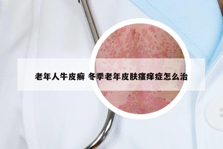 老年人牛皮癣 冬季老年皮肤瘙痒症怎么治