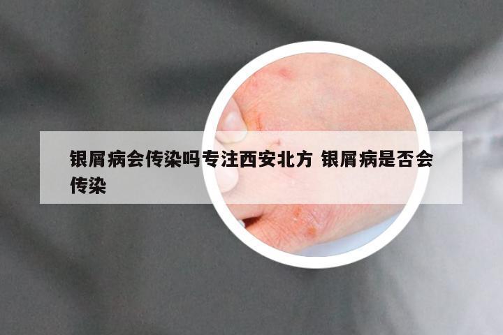 银屑病会传染吗专注西安北方 银屑病是否会传染