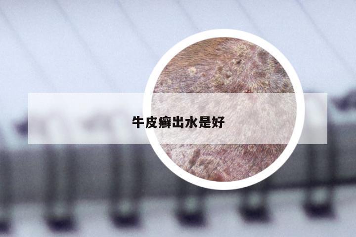 牛皮癣出水是好