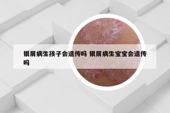 银屑病生孩子会遗传吗 银屑病生宝宝会遗传吗