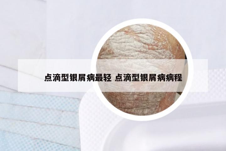 点滴型银屑病最轻 点滴型银屑病病程